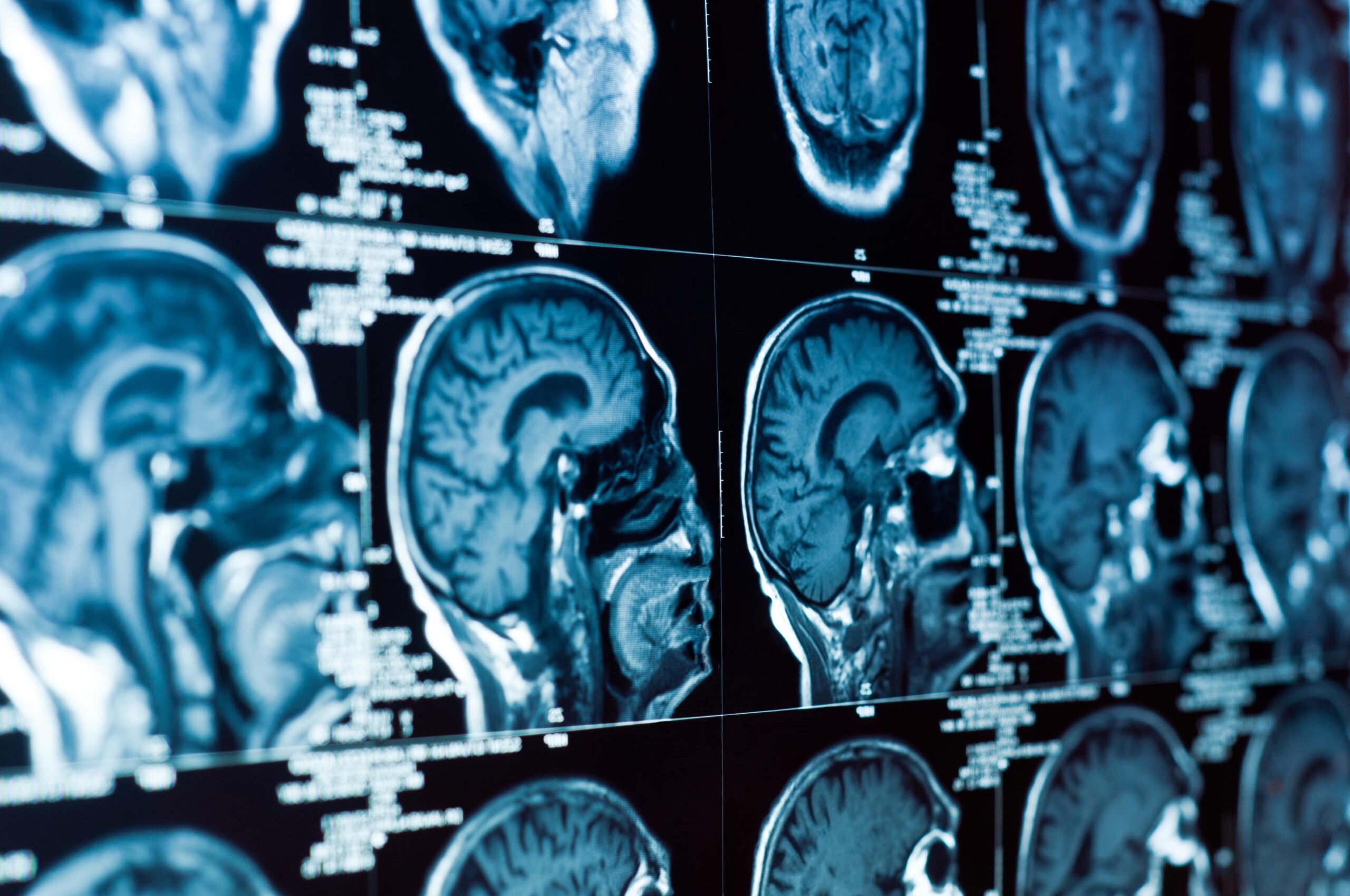 Navigating The Brain Injury Recovery Journey