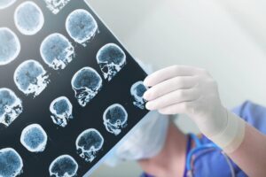 Brain Injury Glossary in Indianapolis, IN
